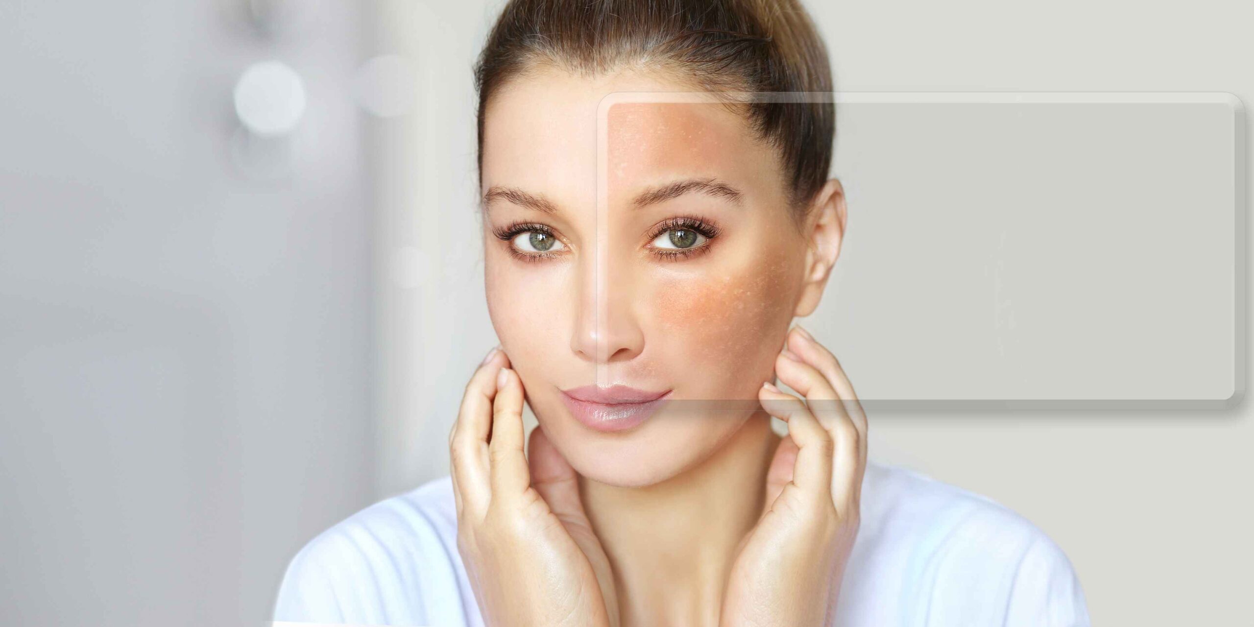 Melasma: Revisão Literária sobre Tratamentos e a Nova Promessa do Tiamidol
