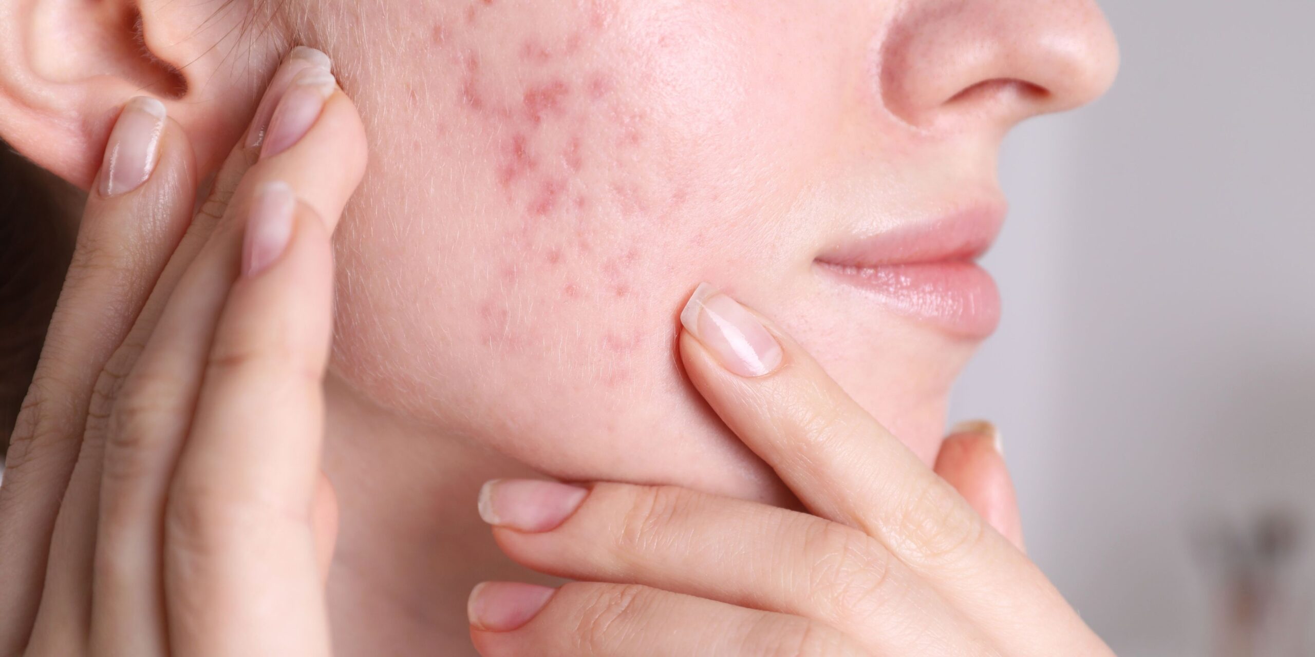 acne