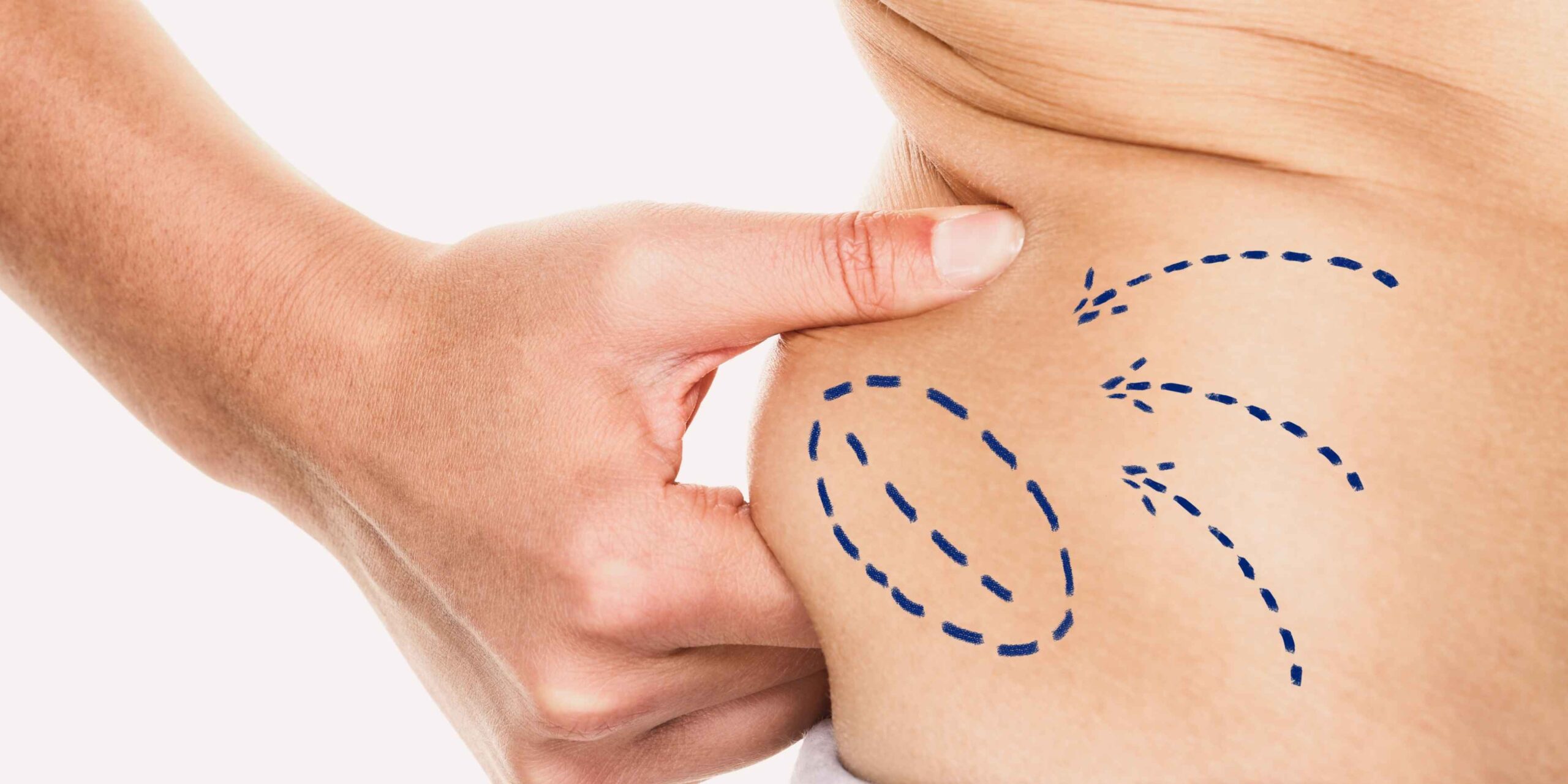 Lipoaspiração: Atualização dos Fatores de Risco Metabólicos e Relevância Clínico-Cirúrgica