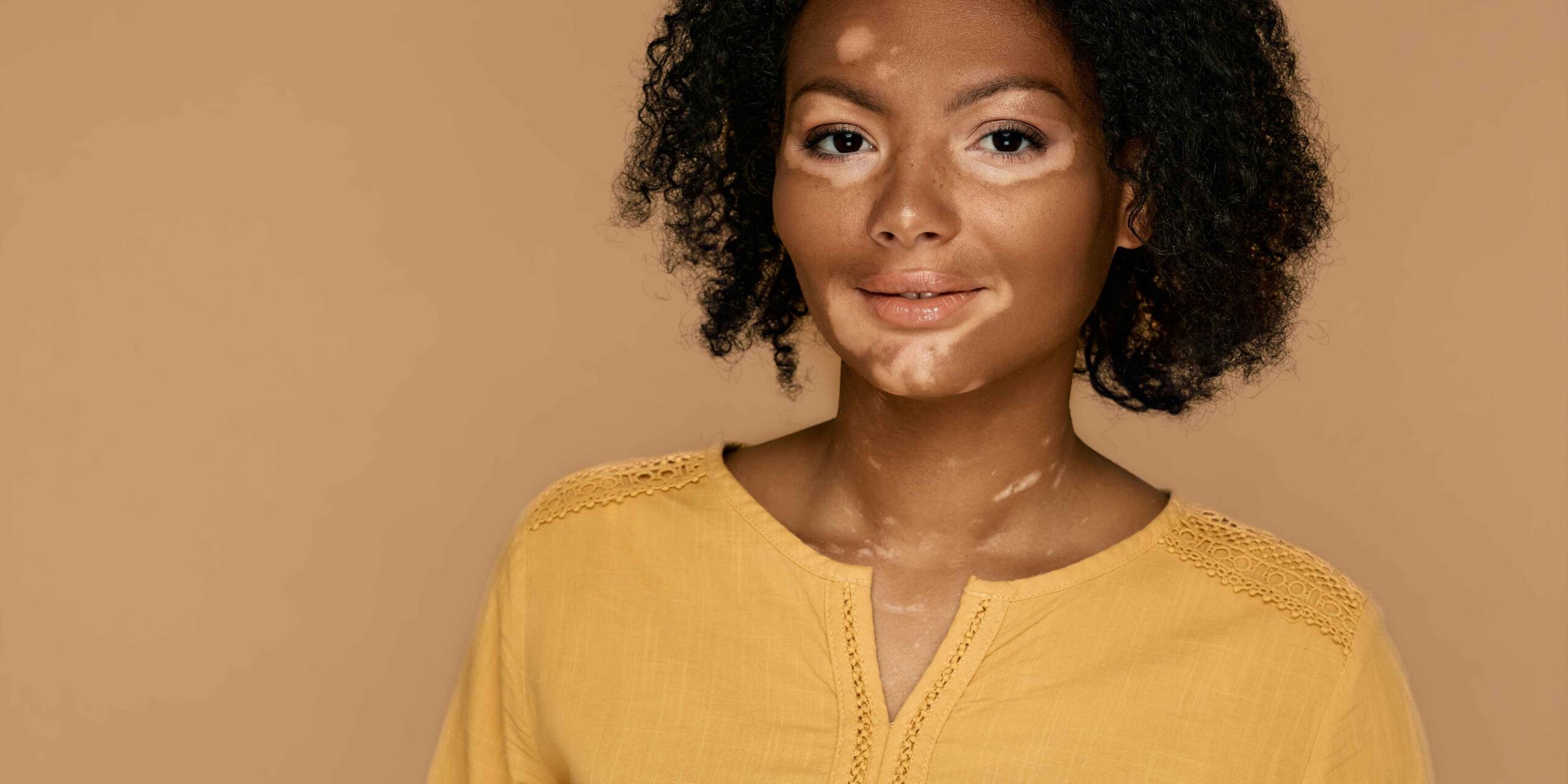 Vitiligo: Causas, Classificação e Tratamentos Atualizados