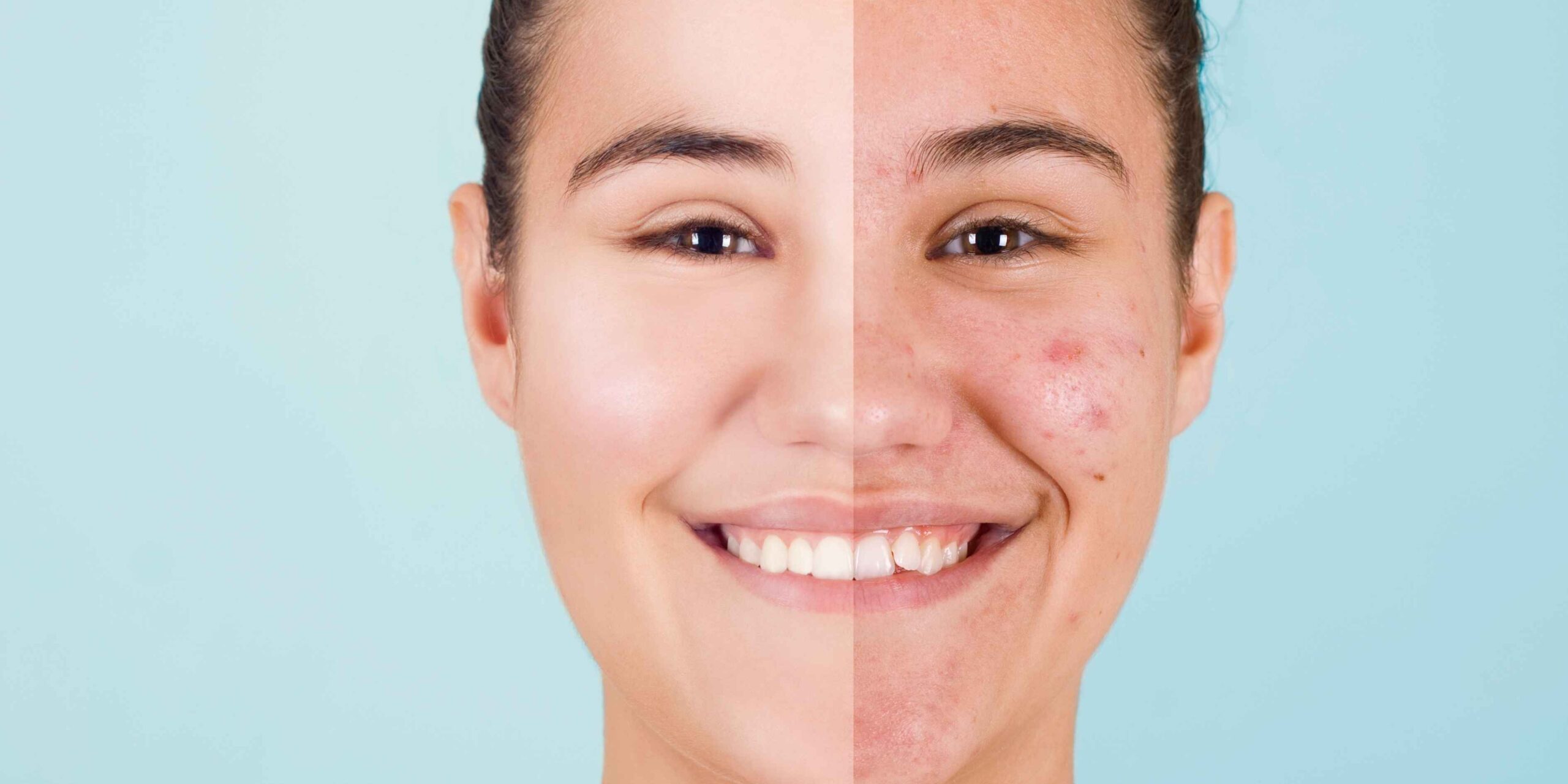 Isotretinoína Oral (Roacutan®): Segurança, Efeitos Colaterais e Avaliação Clínica