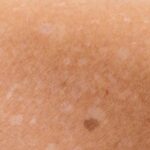 Leucodermia