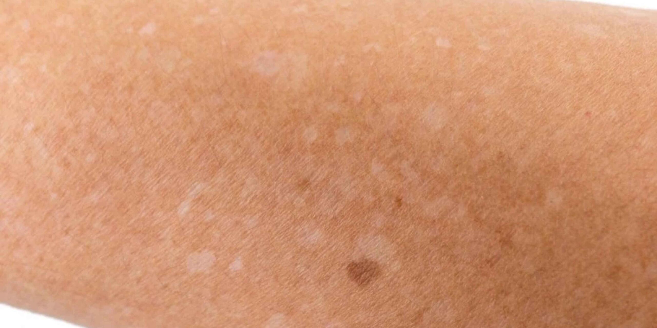 Leucodermia